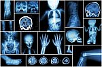 X-ray Multiple Part Of Child 's Body & Multiple Disease ( Stroke , Brain Tumor , Rheumatoid Arthritis , Sinusitis , Gouty Arthritis , Etc)( Skull Chest Lung Heart Spine Arm Hand Pelvis Leg Knee Foot ) Stock Photo